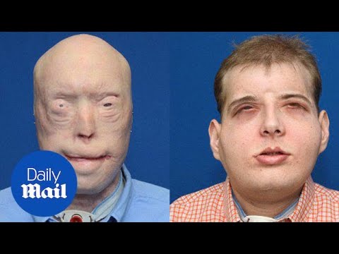 Details of the most extensive face transplant ever explained - Daily Mail